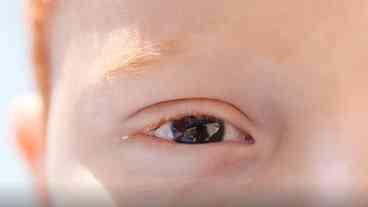 Erros de Refração: Causa de Deficiência Visual Infantil