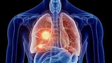 Câncer de Pulmão: Principal Causa de Mortalidade em Mulheres