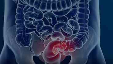 Câncer Colorretal: Diagnóstico Avançado e Prevenção