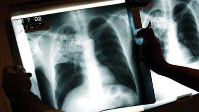 tuberculose.jpg