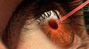 olho-laser-300x168.gif