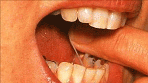 dente-limpeza-300x168.gif